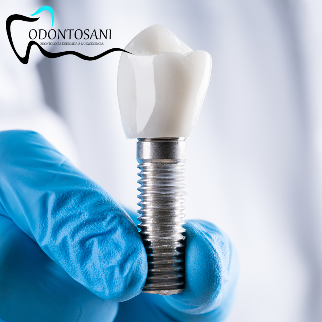 IMPLANTES