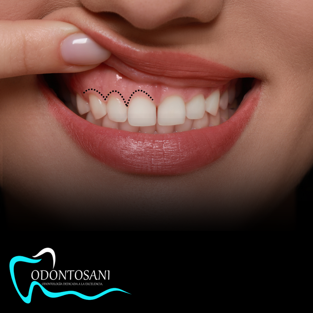 GINGIVECTOMIA