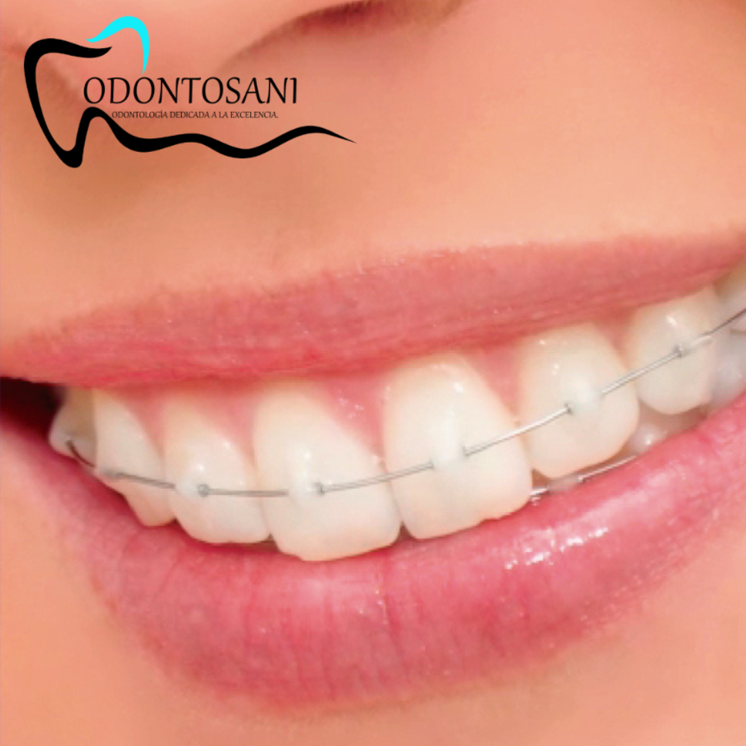 ORTODONCIA SIN BRACKETS