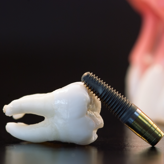 ¿Los implantes dentales son convenientes para usted en Doctororal Cali?