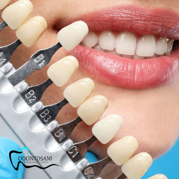 DISEÑO DE SONRISA