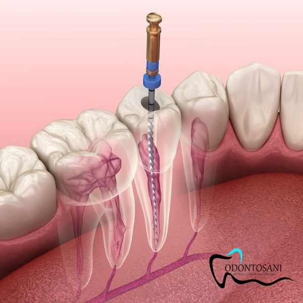 ENDODONCIA